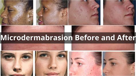 The Different Types Of Treatments For Hyperpigmentation Justinboey