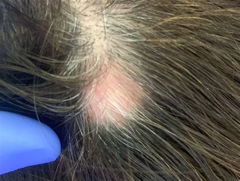 White Hairs In Alopecia Areata Why Do They Occur — Donovan Hair Clinic