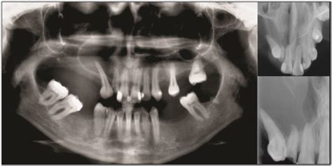 Inflammatory Periapical Cyst Decompression Case Report With Follow Up