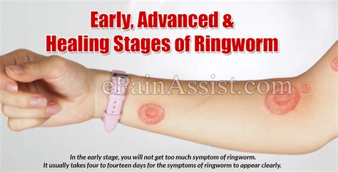 Healing Ringworm Stages Pictures The Meta Pictures