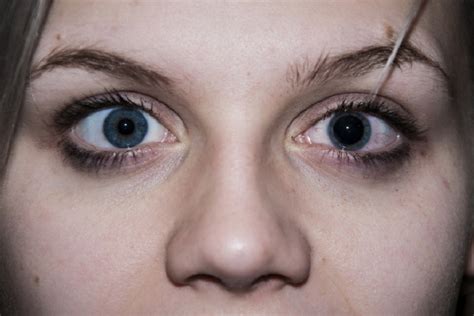 Mydriasis Dilated Pupil Causes Symptoms And Treatment Scope Heal