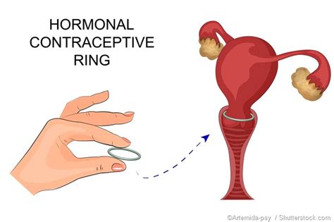 Comment insérer un diaphragme un capuchon ou un anneau vaginal TJMBB