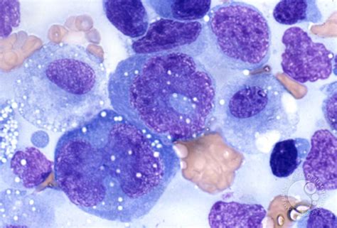 Anaplastic Large Cell Lymphoma 5