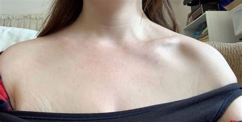 Clavicle Bone Lump What Are The Symptoms Causes And Treatment