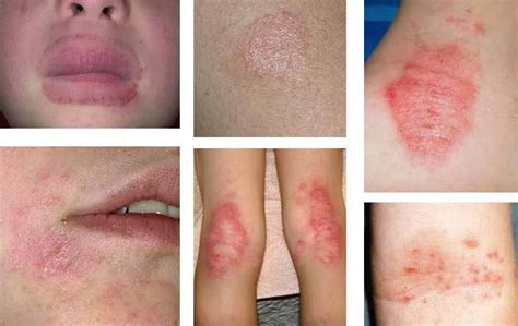 Fungal Infections Natural Remedies For Fungal Infections Yeast