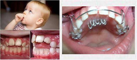 Pediatric Dentistry By Uday Dental Care