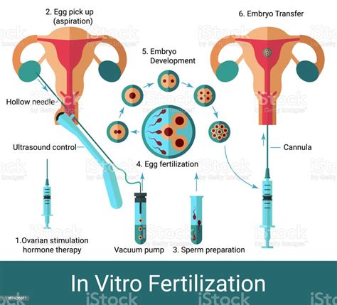 Qual A Diferença Entre Inseminação Artificial E Fertilização In Vitro