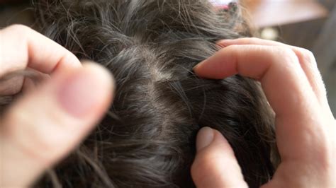 Doctors Are Begging People To Not Try The Scalp Popping Trend That Is
