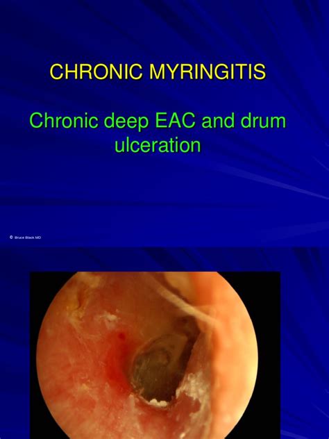 3 Chronic Myringitis Pdf Otology Human Head And Neck