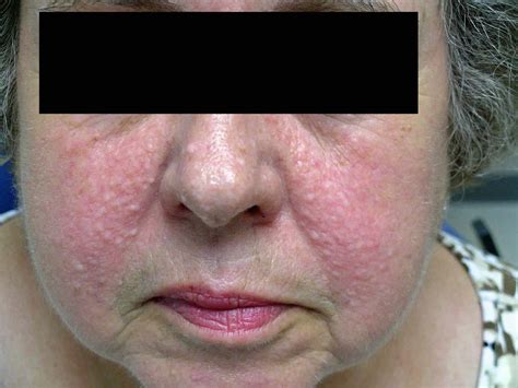 Papule Or Fibrous Papules On Nose Causes Diagnosis And Papule Treatment