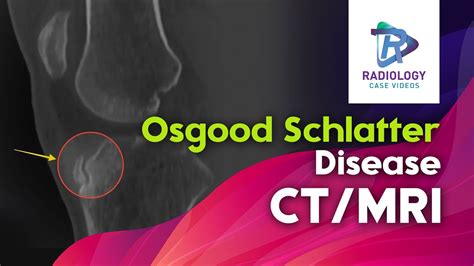 Osgood Schlatter Disease Ct And Mri Anterior Knee Paintibial Tubercle