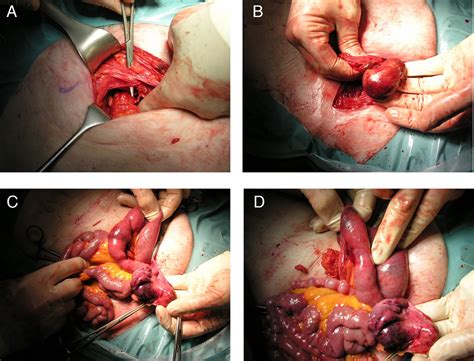 Coexisting ipsilateral right femoral hernia and incarcerated obturator hernia | BMJ Case Reports