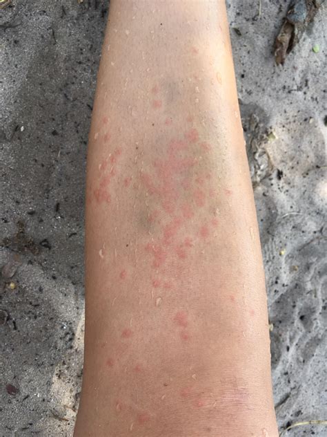 Itchy Red Bumps After Swimming In The Ocean Think It Was Caused By A