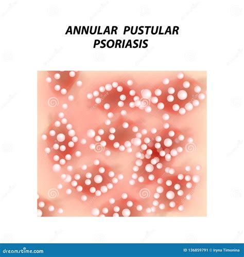 Annular Pustular Psoriasis Eczema Dermatitis Skin Disease Psoriasis