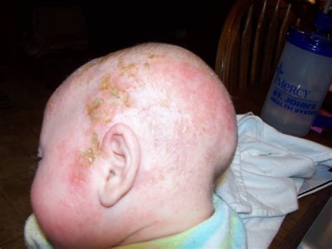 Pictures Of Baby Cradle Cap Mommyhood101