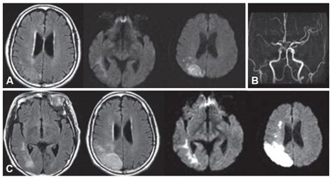A Brain Mri On Admission Shows An Acute Right Parietal Lobe Infarction