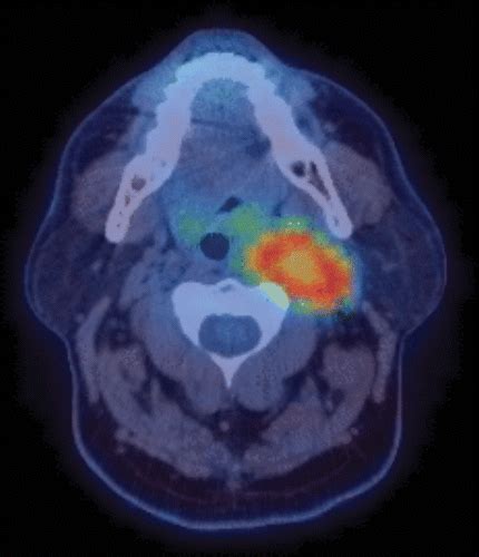 Imaging Features Of Succinate Dehydrogenasedeficient Pheochromocytoma