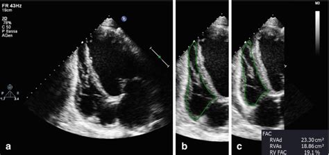 Fig 78 Two Dimensional Transthoracic Echocardiography Of Dilated