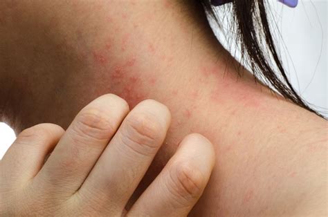 Atopic And Contact Dermatitis How They Differ