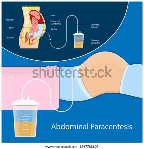 Ascites Paracentesis Medical Procedure Diagnostic Abdominal Stock