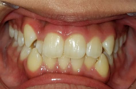 How To Fix Crooked Or Crowded Teeth Causes Issues And More
