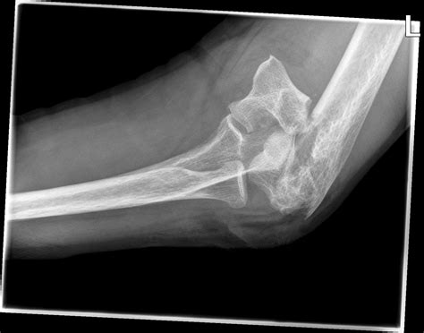 Comminuted C2 Articular Distal Humerus Fracture Without Osteotomy