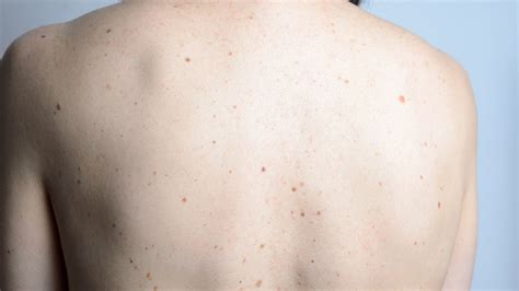 Skin Concerns Some People Have Beauty Marks Like Speckled Eggs All