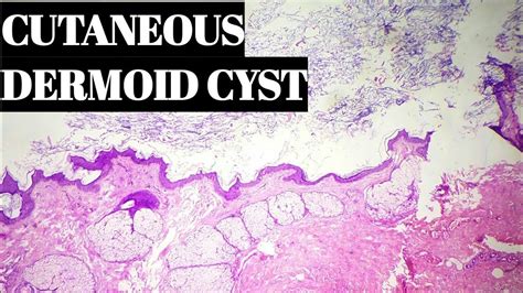 Cutaneous Dermoid Cyst How To Diagnose Youtube