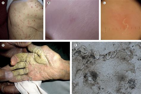 Scabies Signs Papules A Burrows B Burrows Under Dermatoscopy
