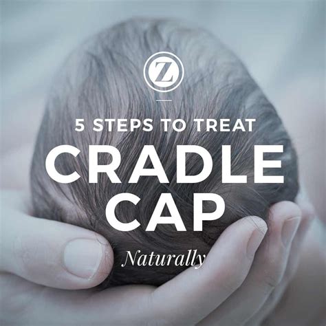 5 Steps To Treating Cradle Cap Naturally Cradle Cap Cradle Cap