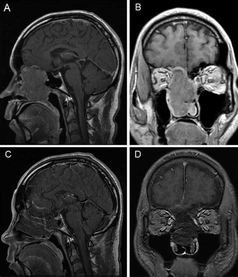 Skull Base Tumors Viewpoint—surgery Radiology Key