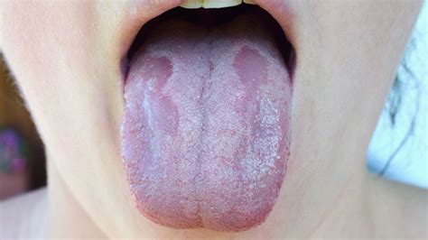 Confira aqui as principais doenças da língua seus sintomas e como tratar