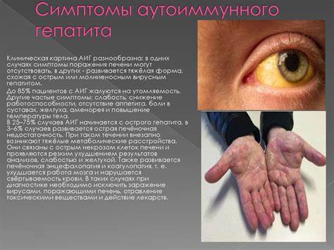 Гепатит симптомы диета Аутоиммунный гепатит - online presentation Аутоиммунный гепатит - online presentation Гепатит симптомы диета