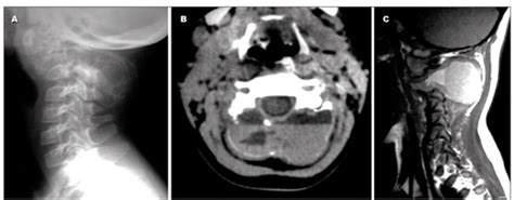 Scielo Brasil Aneurysmal Bone Cyst At C2 Imaging Evaluation After