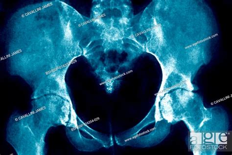 Osteoarthritis Of The Hips Coxarthrosis Visualized By A Pelvic X Ray