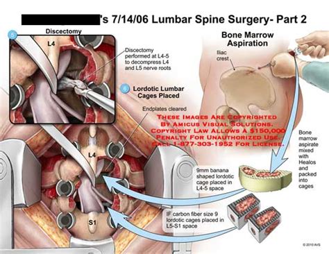Amicus Illustration Of Amicussurgerylumbarspinepart2discectomyl4