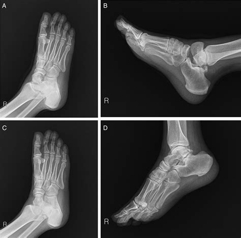 Fracture of the Posterior Process of the Talus With ...
