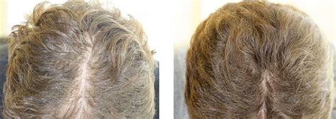 The laser beams of the comb works in a similar way as the cells of the scalp work. 3 in 1 laser hair restoration comb (soft laser+ micro ...