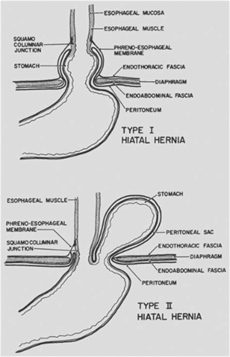 Paraesophageal Hiatal Hernia Thoracic Key