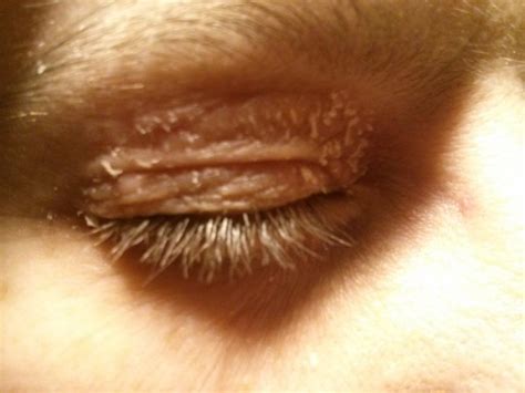 Waking up with an upper swollen, or puffy, eyelid can be disturbing and uneasy, but with these treatments, the issue can be alleviated. Extreme dry skin around eyes?!