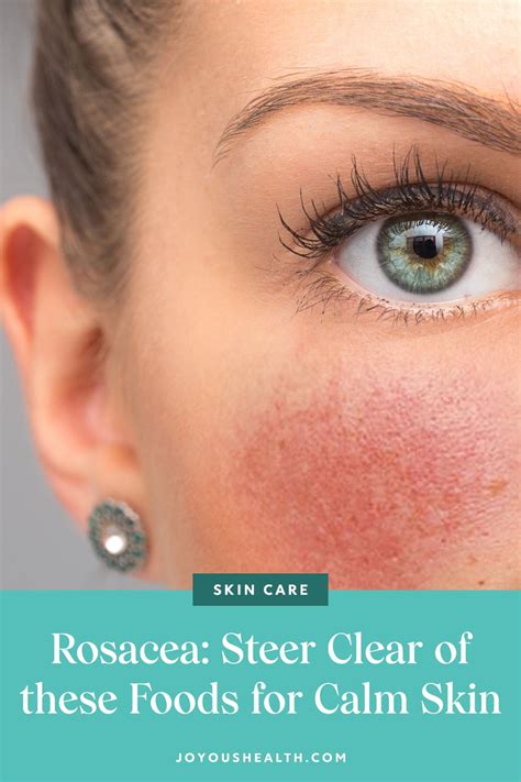 Rosacea Steer Clear Of These Foods For Calm Skin Skin Calming