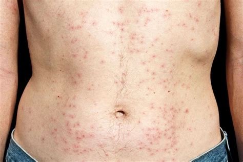 Bacterial Skin Rash 9 Common Infections