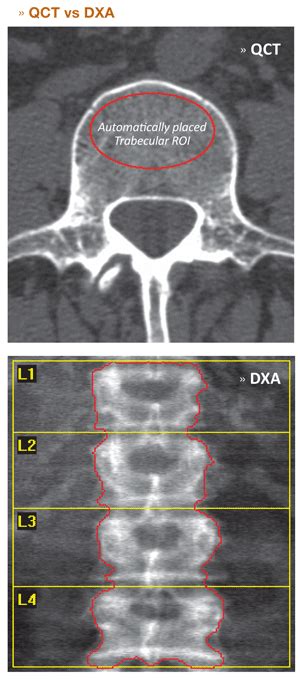 Bmd Spine Qct Software Solutions Mindways Software Inc