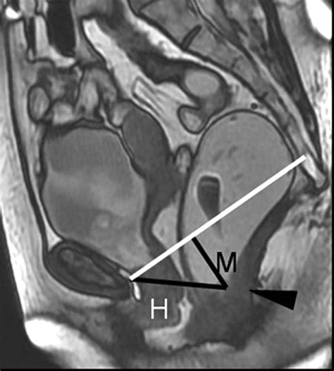 Dynamic Mr Imaging Of The Pelvic Floor A Pictorial Review Radiographics