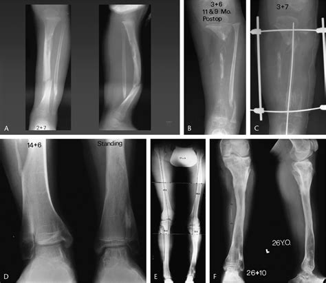 The Treatment Of Congenital Pseudarthrosis Of The Tibia With