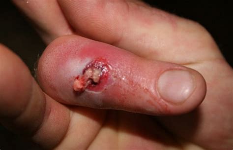 Hookworm Rash Pictures Medical Pictures And Images 2021 Updated