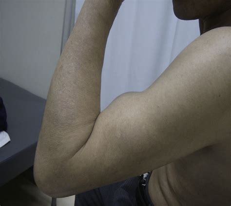 Cosmetic Deformity Of The Upper Arm Caused By Distalization Of The Download Scientific Diagram