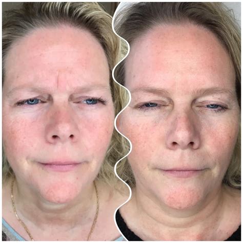Alma Klinik 🌸 Botox 🌸 Karina Ses Her Før Og Efter