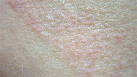 Polymorphous Light Eruptionpmle Pictures And Sun Allergy Rash Images