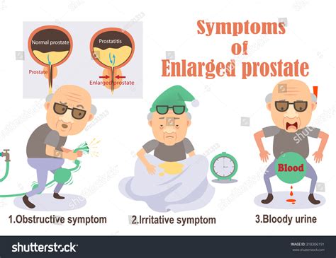 Symptoms Of Enlarged Prostate Infographicvector Illustration